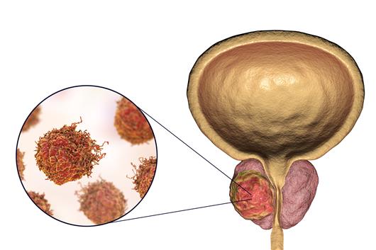 Istock prostatecancer