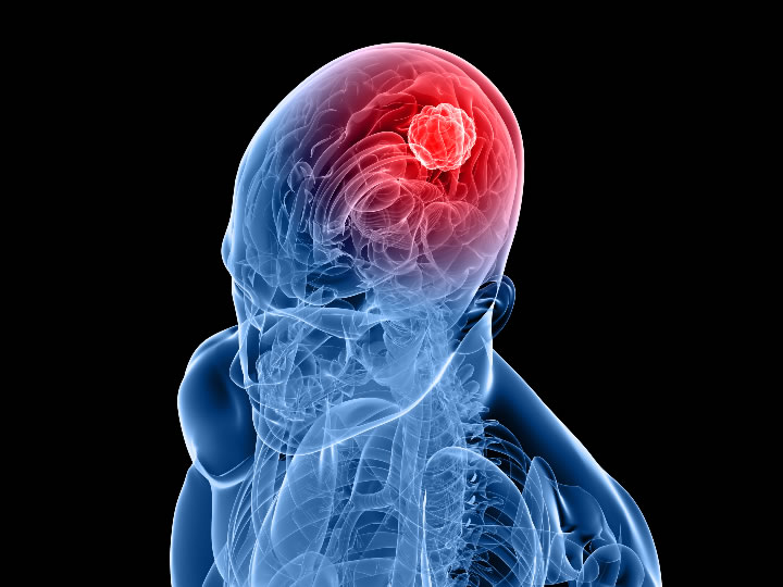 glioblastoma-supplied