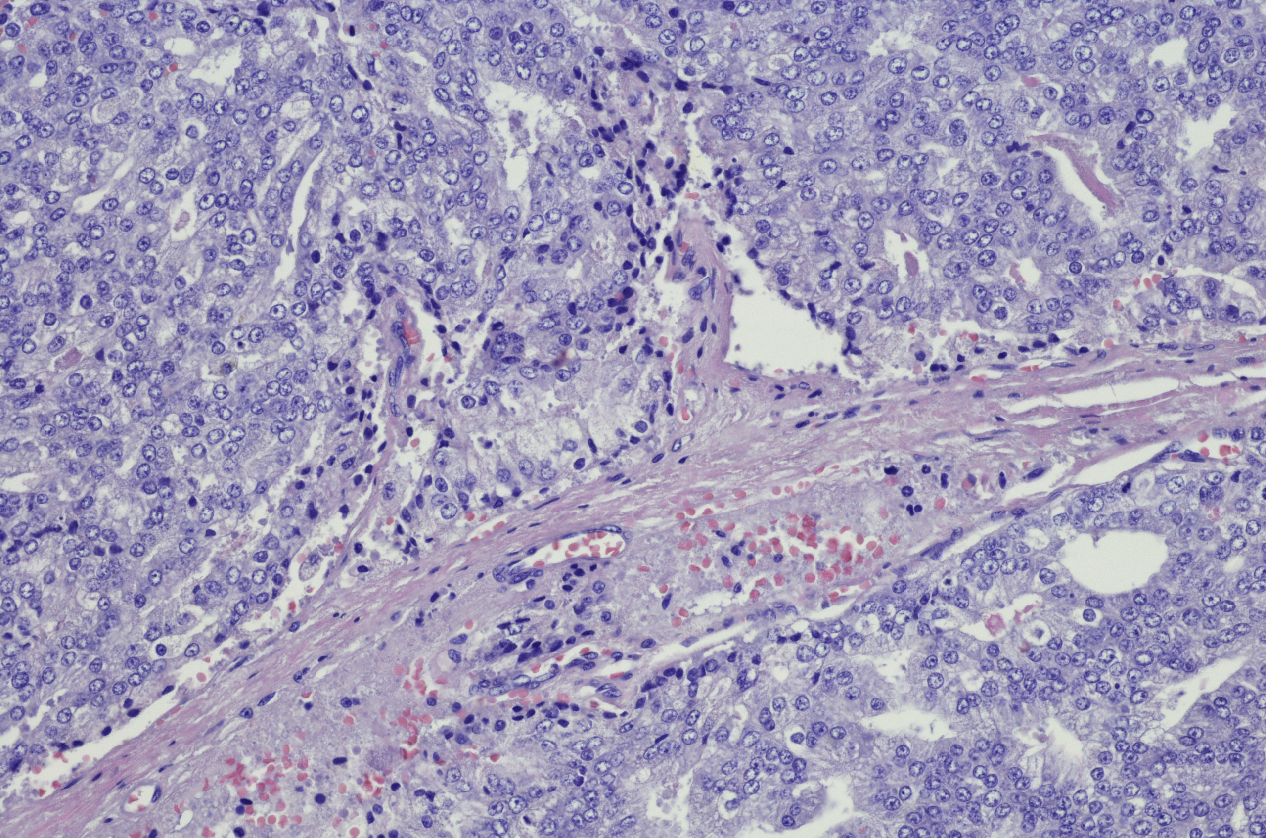 Prostate cancer Prostate cancer